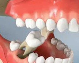 Extracci__n_unit_58bef4981b41f