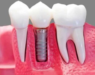 Implante_Dental__58bf2644214bb